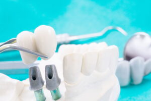 implanty zębów u stomatologa co warto wiedzieć