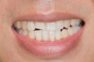 Pęknięty lub złamany ząb - jakie leczenie u dentysty pomoże?